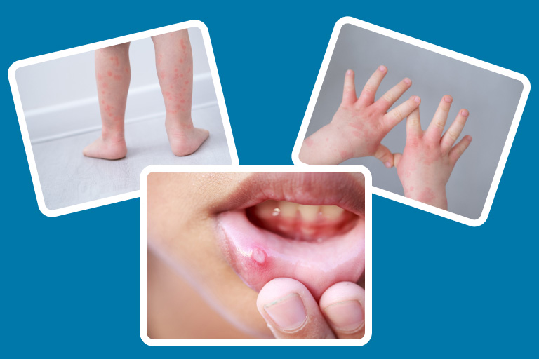 https://kocaelicocukdoktorum.com/wp-content/uploads/2023/07/El-Ayak-Agiz-Hastaligi-Hand-Foot-Mouth-Disease-Uzm.-Dr.-Ayse-Sibel-Tugral-Cocuk-Sagligi-ve-Hastaliklari-Uzmani-–-Kocaeli.jpg